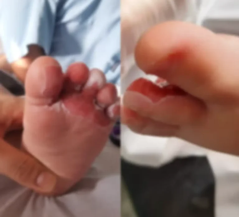 Bebê sofre queimaduras de 2º durante banho em creche de SC